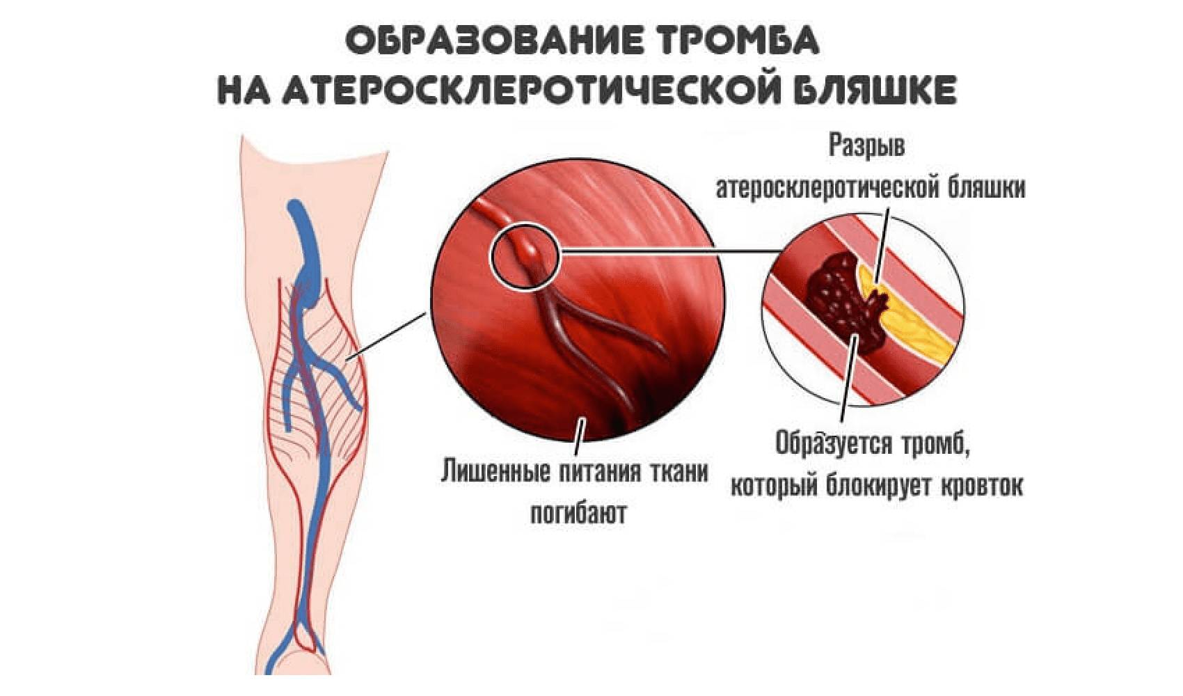 Развития тромбов. Образование тромбов в артериях. Атеросклеротическая бляшка и тромб.